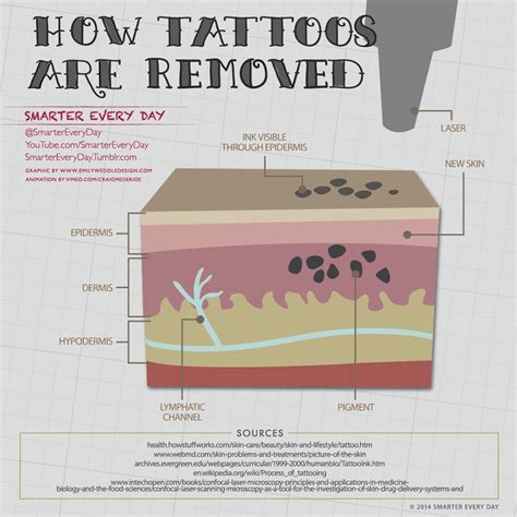 tattoo removal how it works.